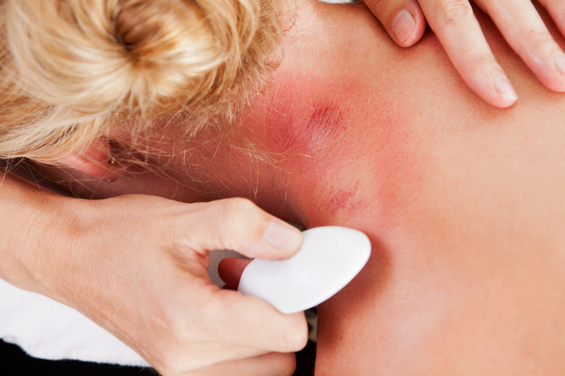 Redness on Neck after Gua Sha Acupuncture